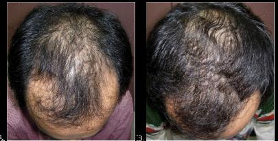 A balding man with hair loss on the top of his head.