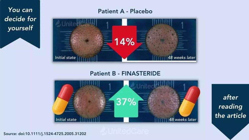 The image shows the comparison of hair growth between two patients, one taking a placebo and the other taking finasteride.
