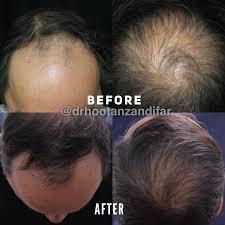 The image shows a man with hair loss before and after a hair transplant.
