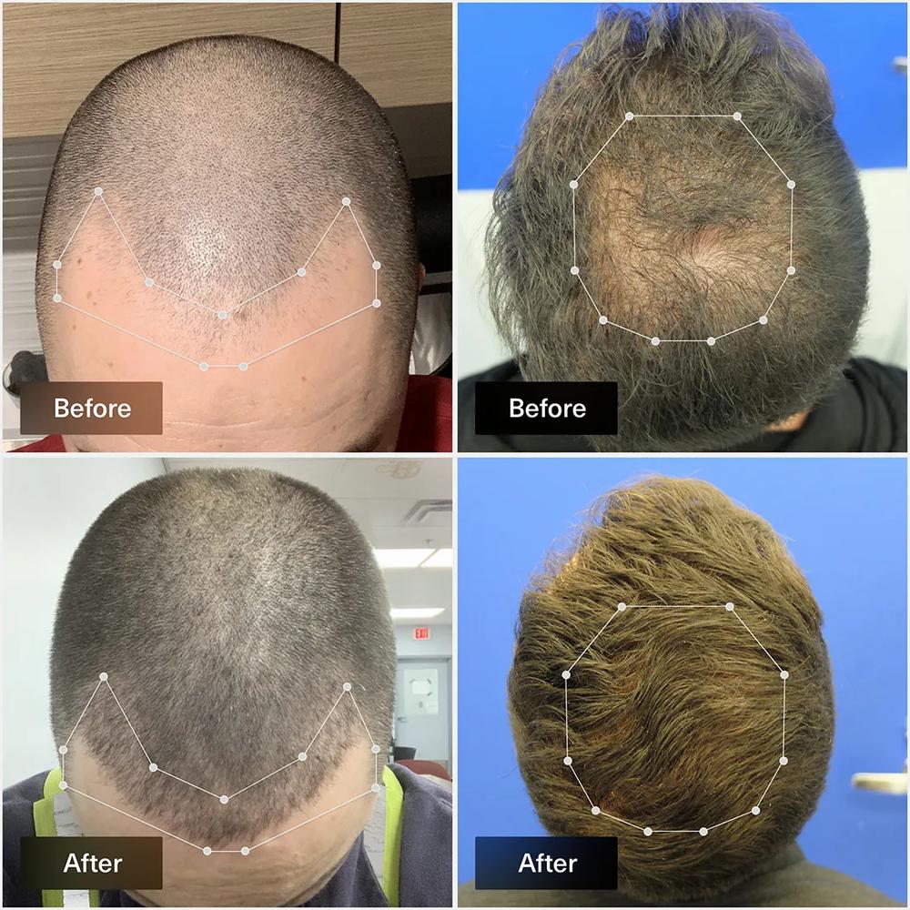 The image shows a comparison of a mans scalp with hair loss before and after treatment.