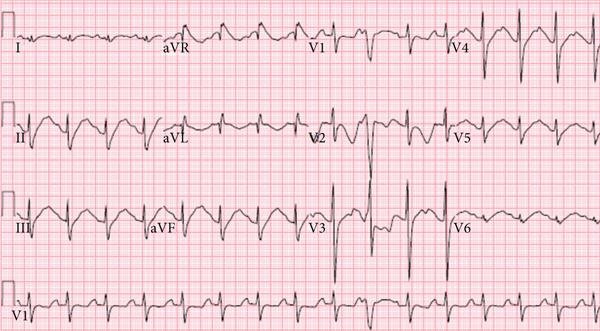 An electrocardiogram image with regular heart rhythm and no major abnormalities.