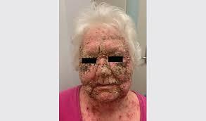 An elderly woman with a crusted facial rash.