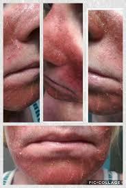 A collage of three photos showing a womans face with atopic dermatitis.