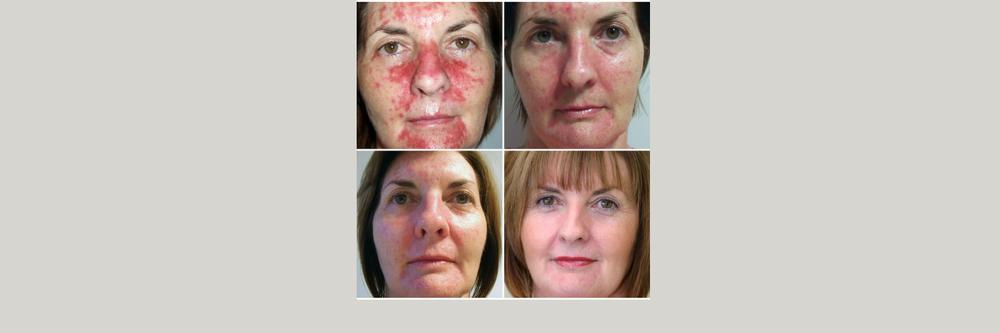 A before-and-after comparison of four women with rosacea who were treated with laser therapy.