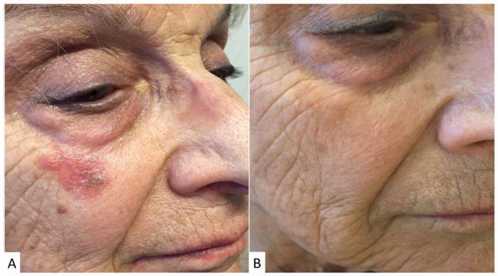 The image shows a woman with a large red birthmark on her face, which has been treated with laser therapy.