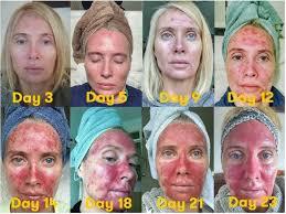 A series of photos shows a womans face with increasing redness and peeling over the course of 23 days.