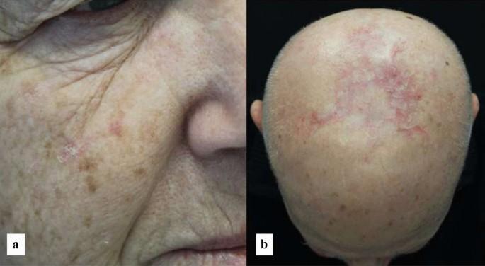 Two images show a person with multiple red, scaly patches on their face and scalp.