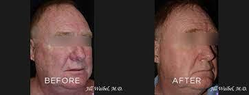 The image shows a man with a large mole on his face, and after the procedure, the mole has been removed.