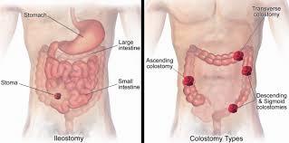 This image shows the different types of ostomies: ileostomy, colostomy, transverse colostomy, ascending colostomy, descending colostomy, and sigmoid colostomy.