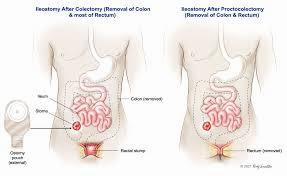 A diagram showing the difference between a colectomy and a proctocolectomy.