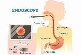 A diagram showing the endoscope passing through the esophagus and into the stomach.