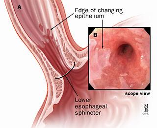 This image shows the anatomy of the esophagus and the location of the lower esophageal sphincter.